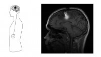 pump delivers chemotherapy directly to the brain